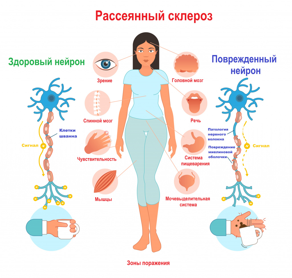 Рассеянный склероз: причины, симптомы и методы лечение